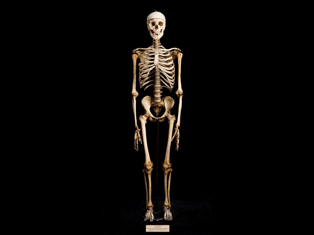 Skeleton Of William Burke. Image Copyright Anatomical Museum Collection, University Of Edinburgh